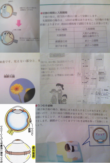 網膜剥離001