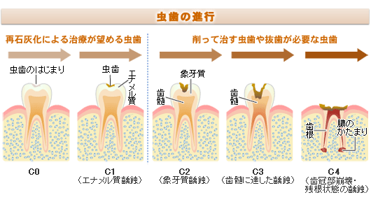 初期虫歯初期虫歯初期虫歯初期虫歯初期虫歯初期虫歯初期虫歯f